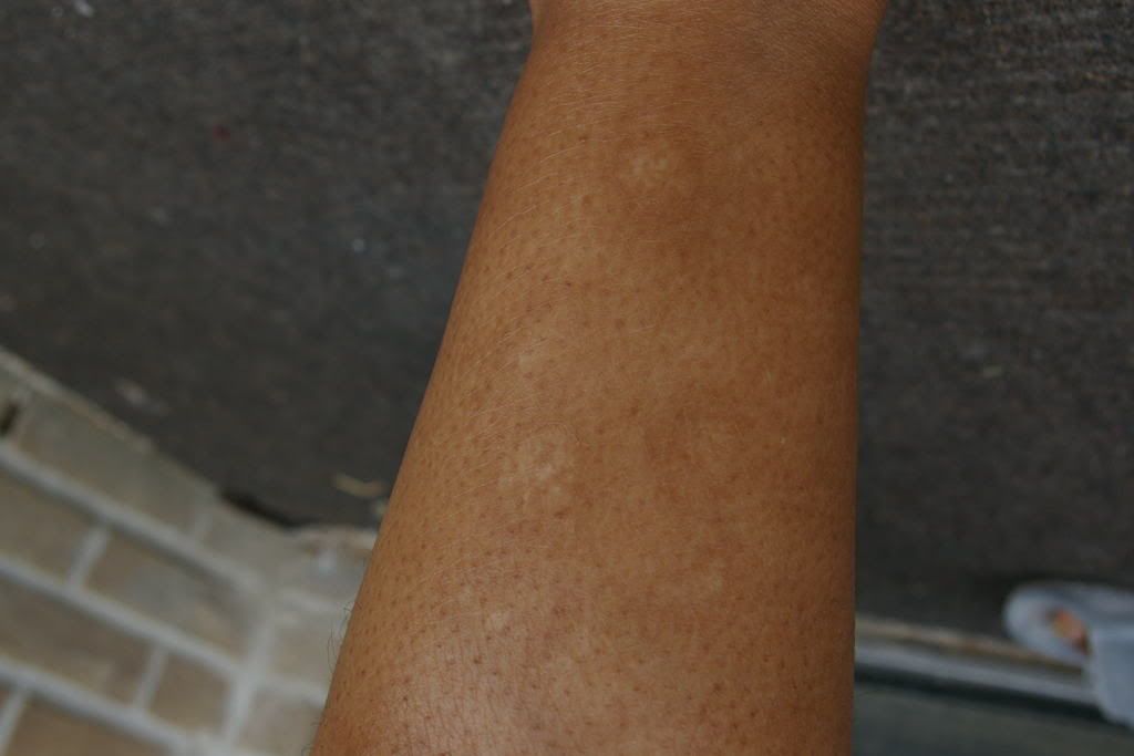  hyperpigmentation, sun damage? What is it and how do I get rid of it